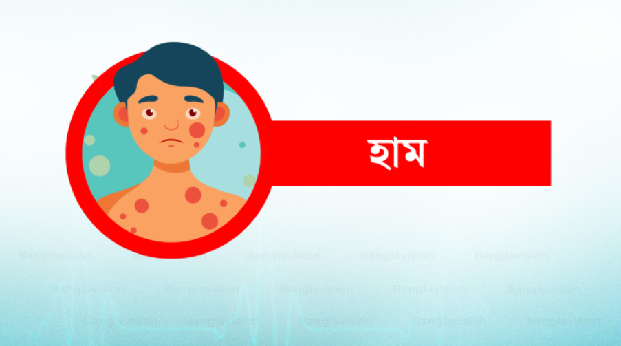 হামের উপসর্গে আরও ৬ শিশুর মৃত্যু, সবাই ঢাকার